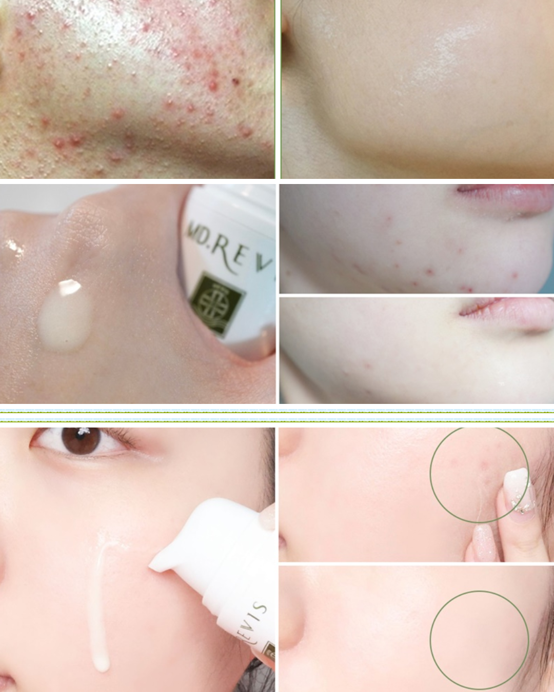 Blemish Control Treatment