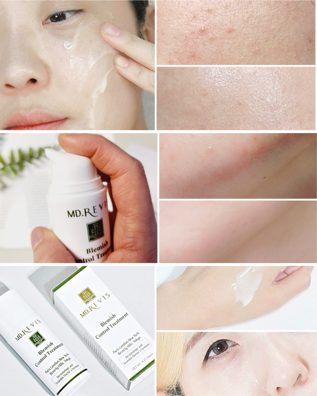 Blemish Control Treatment